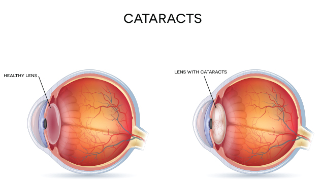 Cataracts diagram